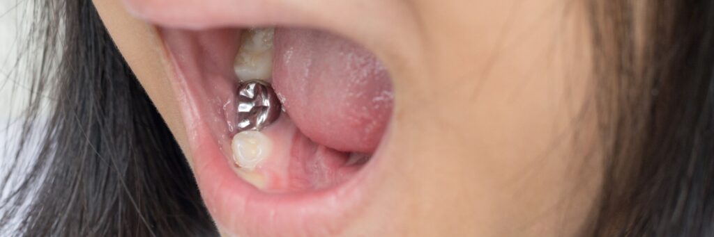 A close up of a child's mouth and teeth with a mercury amalgam filling as a tooth crown.